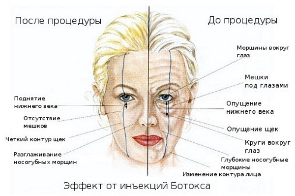 Anatomy of human facial muscles in cosmetology for botox injections. Schemes with descriptions and photos in Latin and Russian