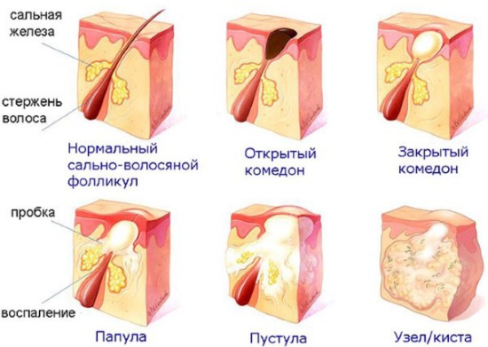 Subcutaneous acne on the face. Reasons how to get rid. Fast treatment with folk remedies, ointments, medicines at home