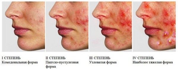 Subcutaneous acne on the face. Reasons how to get rid. Fast treatment with folk remedies, ointments, medicines at home