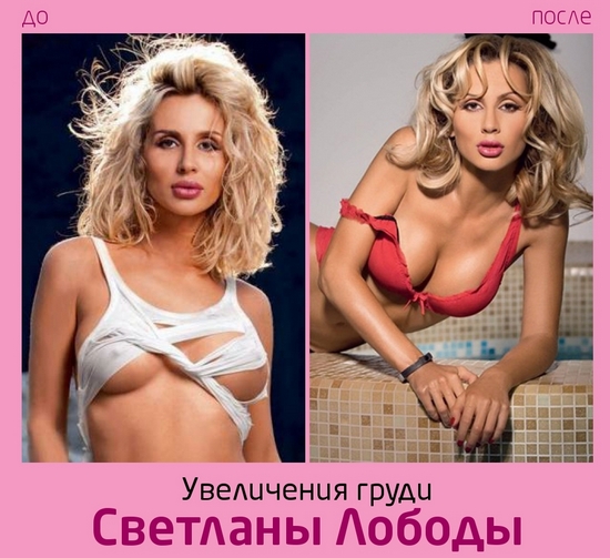 Svetlana Loboda before and after plastic surgery. Photo of face, nose, lips, chest. Singer biography, age, shape parameters, height and weight