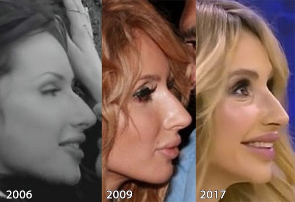 Svetlana Loboda before and after plastic surgery. Photo of face, nose, lips, chest. Singer biography, age, shape parameters, height and weight