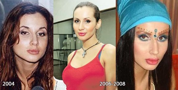 Svetlana Loboda before and after plastic surgery. Photo of face, nose, lips, chest. Singer biography, age, shape parameters, height and weight