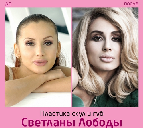 Svetlana Loboda before and after plastic surgery. Photo of face, nose, lips, chest. Singer biography, age, shape parameters, height and weight