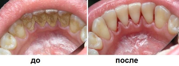 Spazzolino da denti ad ultrasuoni. Pro e contro, recensioni dei medici, valutazione dei migliori e controindicazioni