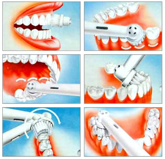 Spazzolino da denti ad ultrasuoni. Pro e contro, recensioni dei medici, valutazione dei migliori e controindicazioni