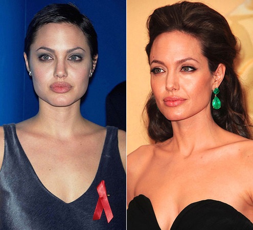 Angelina Jolie before and after plastic surgery. A selection of photos of the actress before and after rhinoplasty, plasma-lifting operations