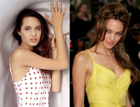 Angelina Jolie before and after plastic surgery. A selection of photos of the actress before and after rhinoplasty, plasma lifting