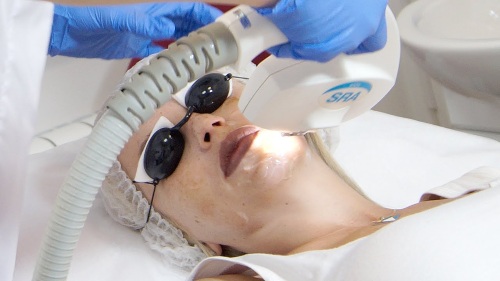 Apparatus for removing age spots, scars, tattoos on the face and body skin. Laser, Fraxel, Elos, M22. Rating and reviews