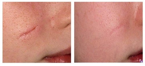 Devices for the removal of age spots, scars, tattoos on the face and body skin. Laser, Fraxel, Elos, M22. Rating and reviews