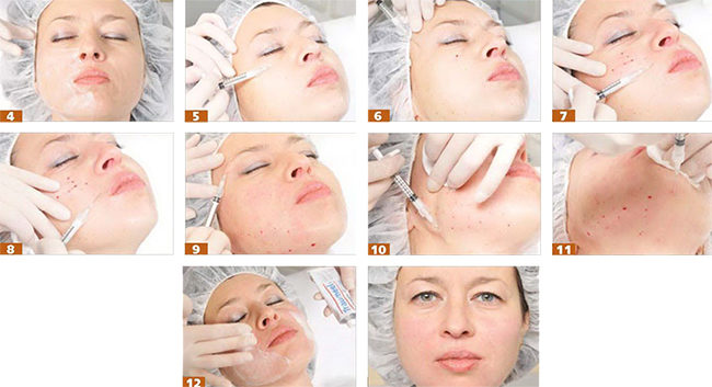 Facial bioreinforcement - what it is, types, how to do the procedure with hyaluronic acid, threads, fillers, drugs. Photos and consequences