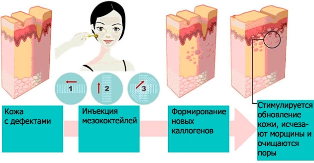 What is biorevitalization of the face, how it differs from mesotherapy, fillers. Indications, contraindications, consequences. A photo