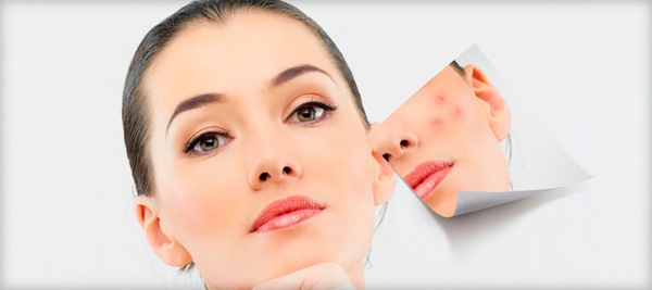 Talker for acne. Recipes with chloramphenicol, salicylic acid, calendula tincture, streptocide