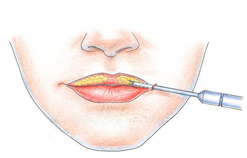 Bulhorn - what kind of operation is it, before and after photos, effectiveness and consequences of the procedure