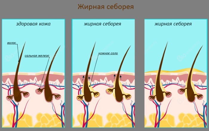 What to do if oily hair at the roots and dandruff, dry at the ends, fall out - the reasons. How to deal - advice from a trichologist