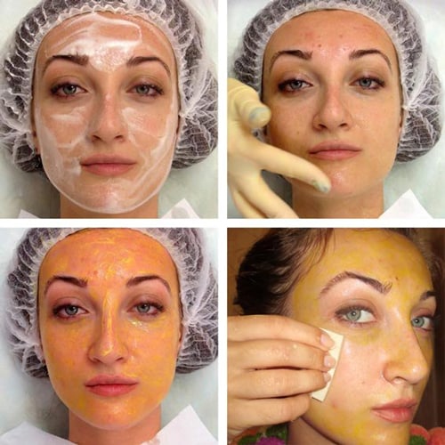 Ferul peeling - what is it, how is it done, acids, protocol of Medderma procedure, reviews, photos and results