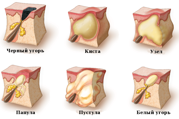 Ferul peeling - what is it, how is it done, acids, protocol of the Medderma procedure, reviews, photos and results