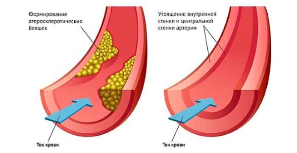 Ferul peeling - what is it, how is it done, acids, protocol of the Medderma procedure, reviews, photos and results