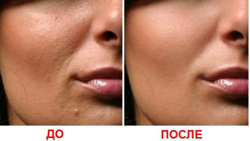 Fractional facial mesotherapy - what is it, how is it done, the effectiveness of scars, stretch marks, bags under the eyes, the price of the course, photos before and after, reviews