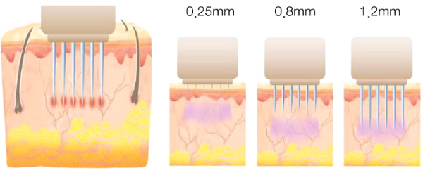 Fractional facial mesotherapy - what is it, how is it done, the effectiveness of scars, stretch marks, bags under the eyes, the price of the course, photos before and after, reviews