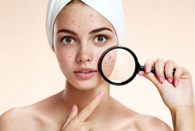 How to quickly get rid of acne and blackheads on the face. Diet, folk remedies, medicinal ointments, creams