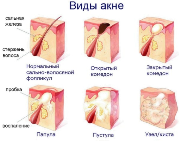 How to quickly get rid of acne and blackheads on the face. Diet, folk remedies, medicinal ointments, creams