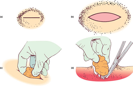 How to get rid of wen on the face. Healing ointments, creams, medicines, folk recipes and remedies