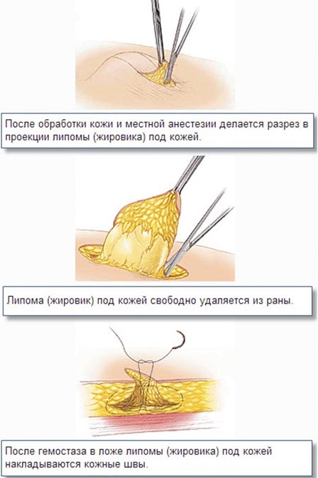 How to get rid of wen on the face. Healing ointments, creams, medicines, folk recipes and remedies