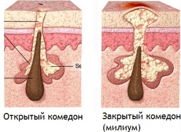 How to get rid of wen on the face. Healing ointments, creams, medicines, folk recipes and remedies