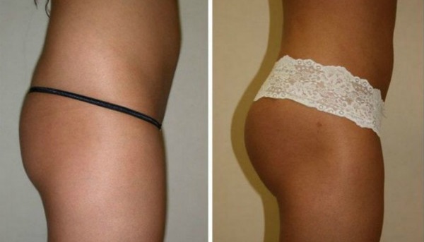 How to remove pits and depressions on the sides of the buttocks. Reasons how to get rid of, exercises, lipolifting, endoprosthetics, mesotherapy, plastic