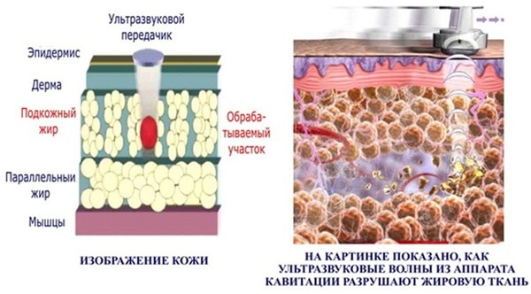 Laser lipolysis - what is it, how is it done, indications and contraindications. Reviews of doctors and patients, photos