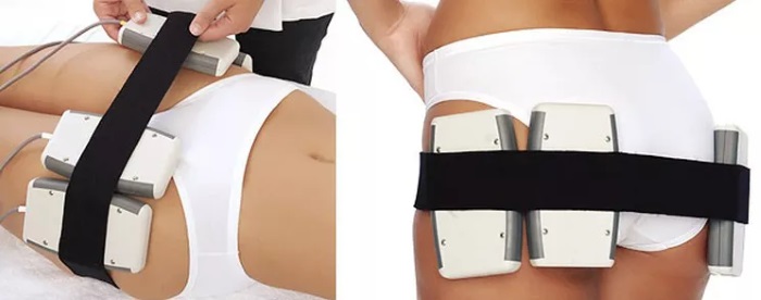 Laser lipolysis - what is it, how is it done, indications and contraindications. Reviews of doctors and patients, photos