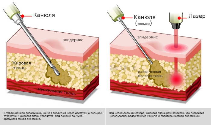 Laser lipolysis - what is it, how is it done, indications and contraindications. Reviews of doctors and patients, photos