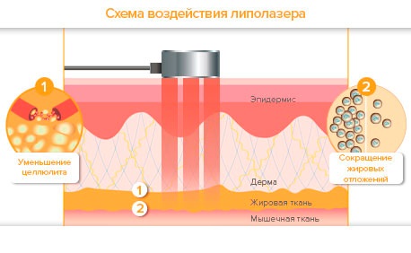 Laser lipolysis - what is it, how is it done, indications and contraindications. Reviews of doctors and patients, photos