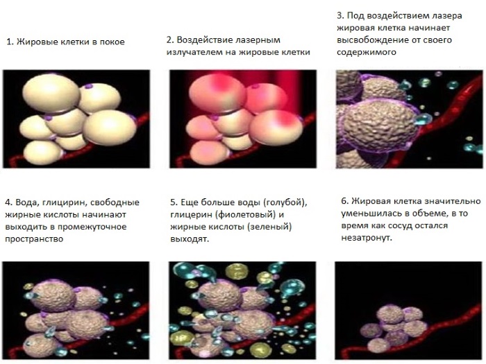 Laser lipolysis - what is it, how is it done, indications and contraindications. Reviews of doctors and patients, photos