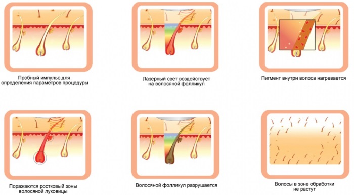 Laser hair removal. Which is better: diode or alexandrite laser for face, body, bikini area. Contraindications and consequences, results, photos