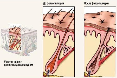 Laser hair removal during pregnancy and lactation, early, late. Is it possible or not, the opinion of doctors