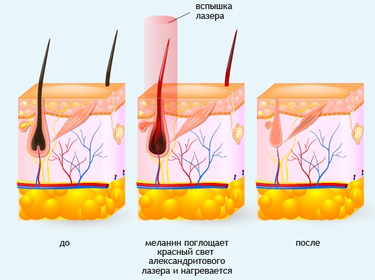 Laser hair removal during pregnancy and lactation, early, late. Is it possible or not, the opinion of doctors