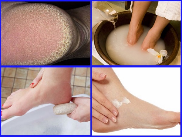 Treatment of the skin on the heels from cracks at home. Folk recipes, pharmaceuticals, ointments, medicines