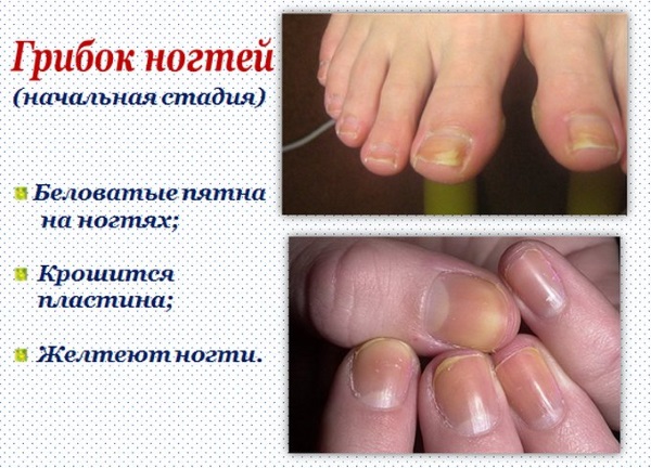 Treatment of nails on hands and feet after gel polish, extension. Folk recipes, pharmacy products, IBX system