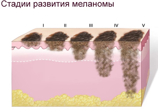 Laser hair removal. Which is better: diode or alexandrite laser for face, body, bikini area. Contraindications and consequences, results, photos