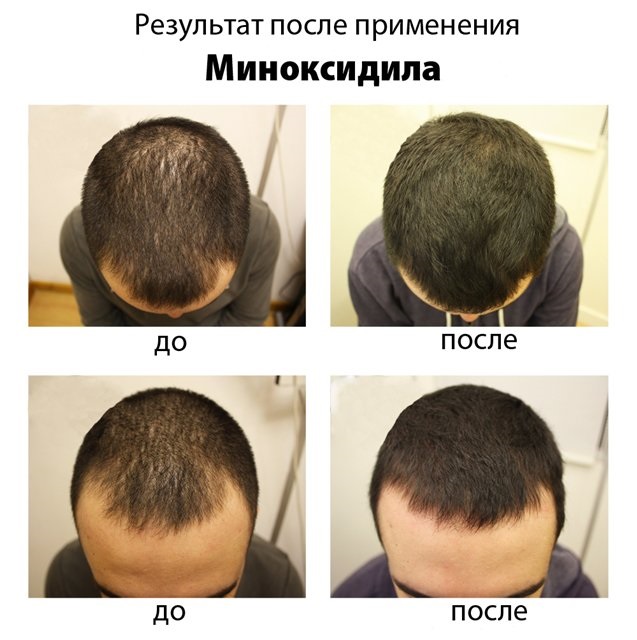 Minoxidil for hair: how it works, effectiveness, before and after photos, reviews. How to apply to women and men, side effects, possible harm. Price and reviews