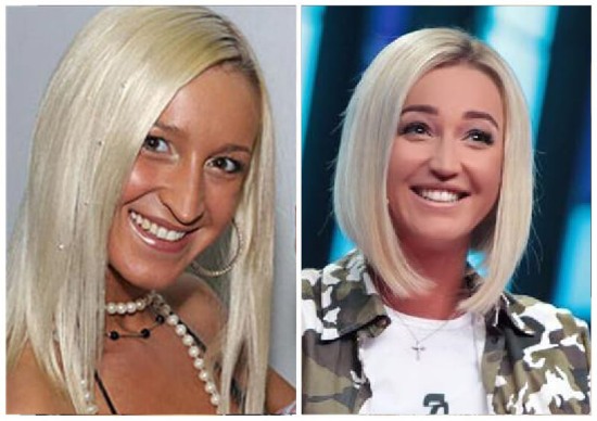 Olga Buzova - photos before and after plastic surgery of the nose, lips, cheekbones. How did I lose weight, what plastic surgery did I do