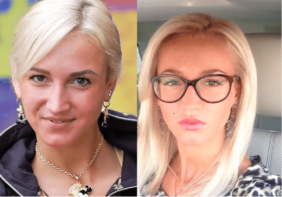 Olga Buzova - photos before and after plastic surgery of the nose, lips, cheekbones. How did I lose weight, what plastic surgery did I do