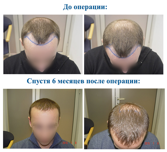 Scalp hair transplant methods for men and women. How is the operation going, HFE, clinic prices, results, photos