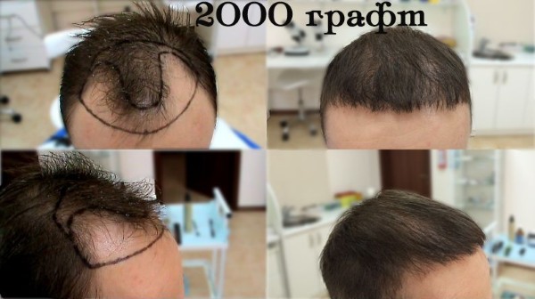 Scalp hair transplant methods for men and women. How is the operation going, HFE, clinic prices, results, photos