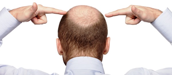 Scalp hair transplant methods for men and women. How is the operation going, HFE, clinic prices, results, photos