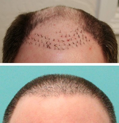 Scalp hair transplant methods for men and women. How is the operation going, HFE, clinic prices, results, photos