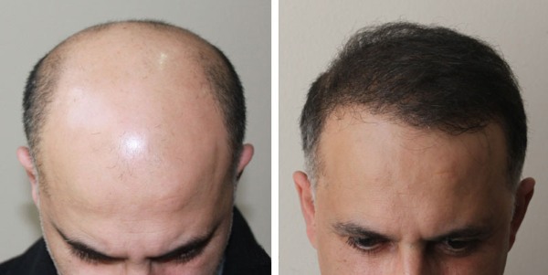 Scalp hair transplant methods for men and women. How is the operation going, HFE, clinic prices, results, photos