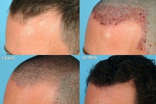 Scalp hair transplant methods for men and women. How is the operation going, HFE, clinic prices, results, photos