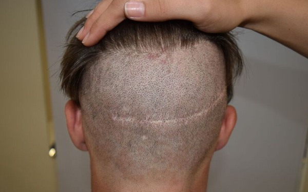 Scalp hair transplant methods for men and women. How is the operation going, HFE, clinic prices, results, photos